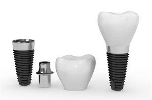 Dental Implants