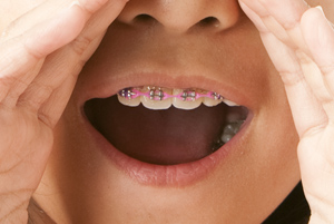 Invisalign