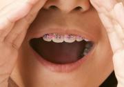 Invisalign