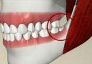 Wisdom Teeth Extraction